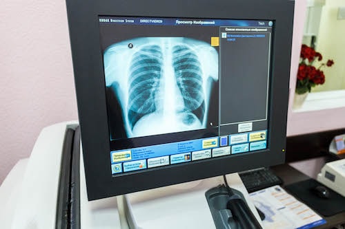 Жители Яйвы смогут пройти рентген в цифровом формате